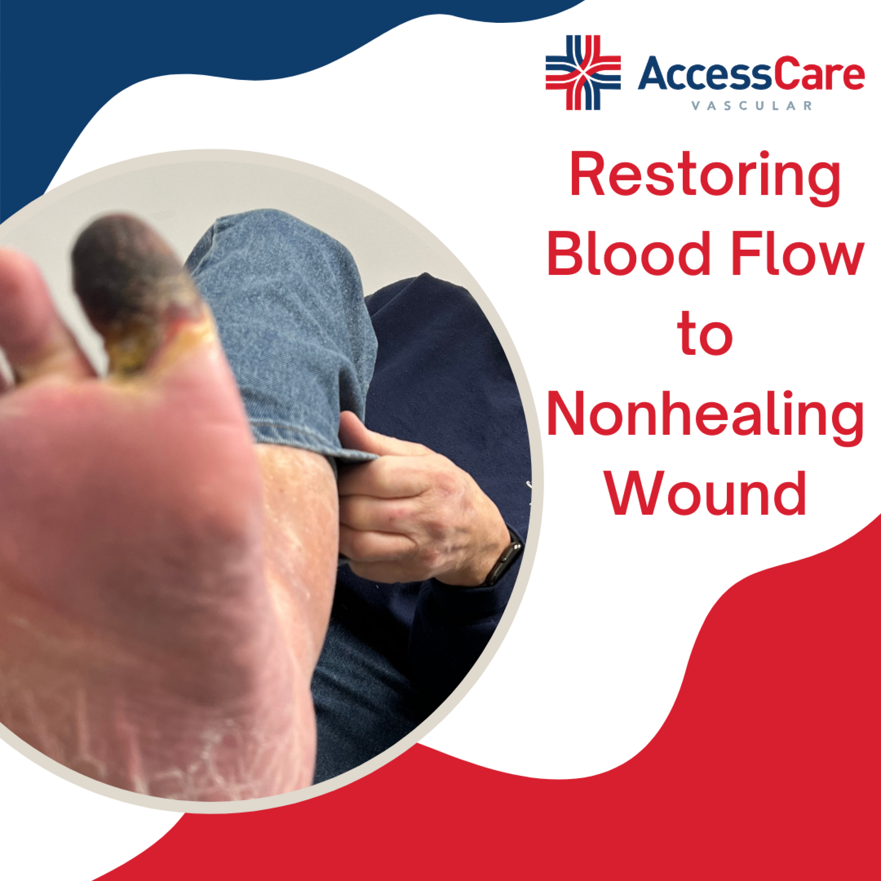 Restoring Blood Flow To Nonhealing Wound Access Care Vascular